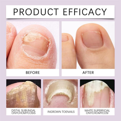 fungi free bee venom nail treatment solution serum